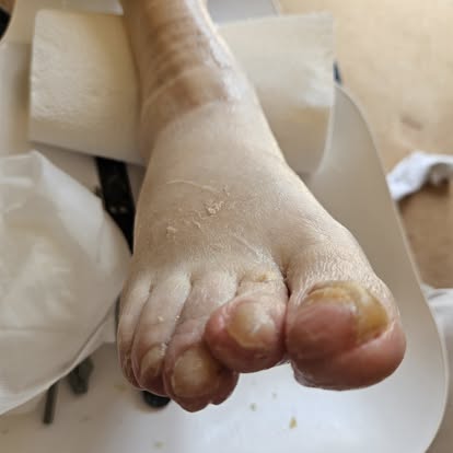 After — Corns