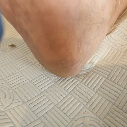 After — Fungal Nail