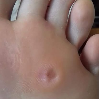 After — Hard Skin
