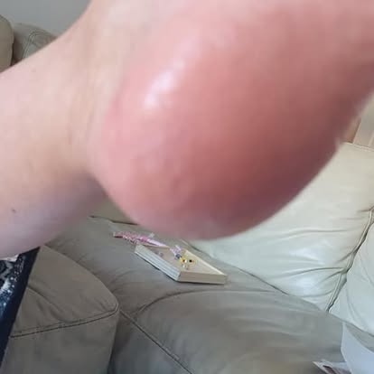 After — Treatment