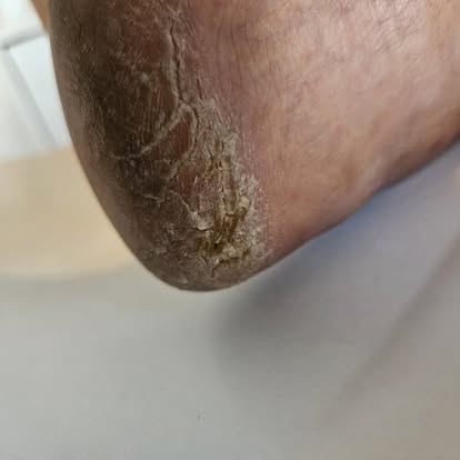 Before — Fungal Nail