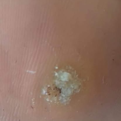 Before — Hard Skin