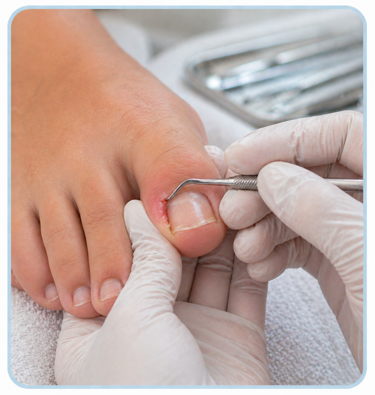 Ingrown toenail treatment